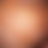 Crusta lactea: Sharply defined, yellowish, greasy scaly and crusty coatings on the capillitium of...