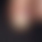 Koenen-Tumor. Detailaufnahme: Multiple, chronisch dynamische, langsam zunehmende, dicht aggregier...