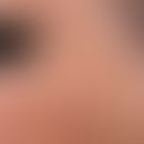 Photodynamische Therapie. Aktinische Keratosen an der Wange einer 52-jährigen Dame. Die AK sind b...