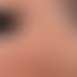photodynamic therapy. actinic keratoses on the cheek of a 52-year-old lady. the AK are better pal...