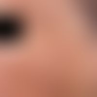 photodynamic therapy. actinic keratoses on the cheek of a 52-year-old lady. the AK are better pal...