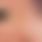 photodynamic therapy. 5 days after PDT with the Metvix-Actilite System. the formerly porphyrin se...