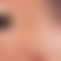photodynamic therapy. 5 days after PDT with the Metvix-Actilite System. the formerly porphyrin se...