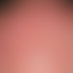 Photodynamic therapy: extensive, strong, painful redness after PDT in a 76-year-old man with mult...