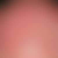 Photodynamic therapy: extensive, strong, painful redness after PDT in a 76-year-old man with mult...