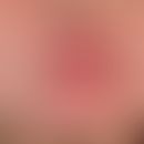 Chemical-Peeling. Stark ausgeprägte hypertrophe Narbenbildung und Narbenkontraktionen, perioral b...