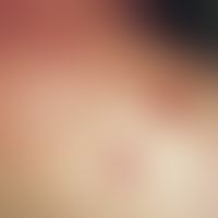Blutegeltherapie. Hämorrhagische Rundherde mit zentralem Blutpunkt nach Blutegeltherapie im Nacke...