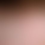 Alopezie, postmenopausale, frontale, fibrosierende. Detailvergrößerung: Vernarbende Alopezie band...