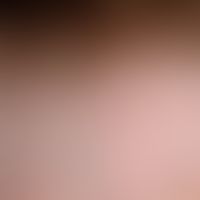 Alopezie, postmenopausale, frontale, fibrosierende. Detailvergrößerung: Vernarbende Alopezie band...