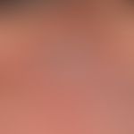 Alopezie postmenopausale frontale fibrosierende: deutliches Zurückweichen der frontalen Haaransat...