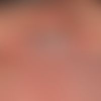 Alopezie postmenopausale frontale fibrosierende: deutliches Zurückweichen der frontalen Haaransat...