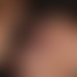 Alopezie, postmenopausale, frontale, fibrosierende. Übersichtsaufnahme: Vernarbende Alopezie band...