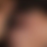 Alopezie, postmenopausale, frontale, fibrosierende. Übersichtsaufnahme: Vernarbende Alopezie band...