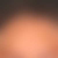 Alopezie postmenopausale, frontale, fibrosierende: gleichmäßiges&nbsp;Zurücktreten der frontalen&...