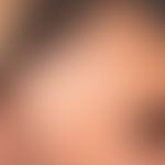Frontal fibrosierende Alopezie : breit zurückgeretene temporale Haargrenzlinie mit einzelnen pers...