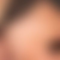 Frontal fibrosierende Alopezie : breit zurückgeretene temporale Haargrenzlinie mit einzelnen pers...
