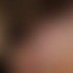Alopezie postmenopausale, fibrosierende mit&nbsp;kompletten Verlust der Augenbrauen (Zustand nach...