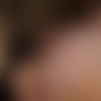 Alopezie postmenopausale, fibrosierende mit&nbsp;kompletten Verlust der Augenbrauen (Zustand nach...