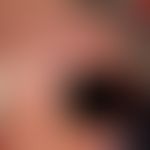 Alopezie, postmenopausale, fibrosierende:&nbsp;chronisch schleichender Haarverlust mit deutlich z...