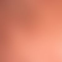 Alopezie, postmenopausale, fibrosierende:&nbsp;Detailaufnahme. Schüttere, vereinzelte&nbsp;Haaran...