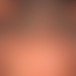 Alopezie, postmenopausale, fibrosierende: typisches klinisches Muster mit der chronisch fortschre...