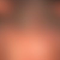 Alopezie, postmenopausale, fibrosierende: typisches klinisches Muster mit der chronisch fortschre...