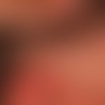 Alopezie, postmenopausale, frontale, fibrosierende. Von der Peripherie aus zentropedal fortschrei...