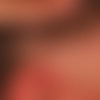 Alopezie, postmenopausale, frontale, fibrosierende. Von der Peripherie aus zentropedal fortschrei...