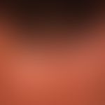 Alopezie, postmenopausale, frontale, fibrosierende:&nbsp;typisches follikuläres Entzündungsmuster...