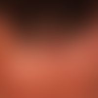 Alopezie, postmenopausale, frontale, fibrosierende:&nbsp;typisches follikuläres Entzündungsmuster...