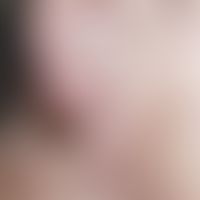 Histiozytosen, Non-Langerhanszell-Histiozytosen. Multiple, rötliche, rötlich-braune oder hautfarb...