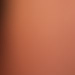 Histiocytosis, non Langerhans cell histiocytosis. multiple, approximately 0.2 cm large, firm, sur...