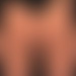 Histiocytosis, non Langerhans cell histiocytosis, multiple approximately 02 cm high, firm, surfac...