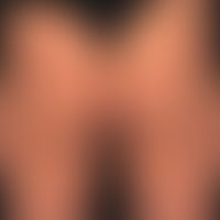 Histiozytose, Non Langerhanszell-Histiozytose. Multiple etwa 02 cm große, feste, oberflächenglatt...