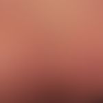 Histiocytosis, non Langerhans cell histiocytosis, multiple, disseminated but also in stripes of a...