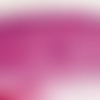 Lymphom, kutanes T-Zell-Lymphom, großzelliges, CD30-positives. Teils diffuse, teils knotige Infil...