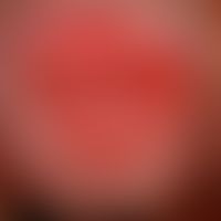 Balanitis plasmacellularis: Chronische Balanitis&nbsp;bei einem 62 Jahre alten Patienten.&nbsp;Ke...