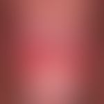 DD Erythroplasia: Balanitis plasmacellularis: For 1.5 years recurrent, in the meantime also heali...