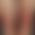 Bullosis diabeticorum: Spontaneously occurring extensive subepithelial blister formation on both ...