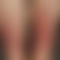 Bullosis diabeticorum: Spontan&nbsp;aufgetretene großflächige, subepitheliale Blasenbildng&nbsp;a...