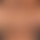 Acanthosis nigricans benigna:&nbsp;symmetrische, schwarzbraune Hyperpigmentierungen (Flecken und ...
