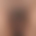 Acanthosis nigricans (Übersicht):&nbsp;benigne Acanthosis nigricans&nbsp;bei einem (adipösen) Süd...