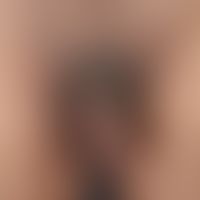 Acanthosis nigricans (overview): benign acanthosis nigricans in a (obese) Southern European with ...