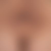 Acanthosis nigricans (benigna): generalized clinical picture with pigmented, blurred, symptomless...