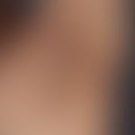 Acanthosis nigricans (Übersicht): benigne Acanthosis nigricans&nbsp;bei einem (adipösen) Südeurop...