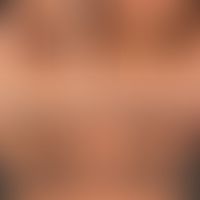 Acanthosis nigricans benigna: symmetrische, schwarzbraune Hyperpigmentierungen mit&nbsp; samtarti...