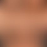 Pseudoacanthosis nigricans: symmetric, black-brown hyperpigmentations with velvety, partly also v...
