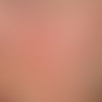 Plaqueförmige Muzinose der Haut: Follikel-betonende (peau d ´orange)&nbsp;Einlagerungen von Muzin...