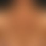 Amyloidosis macular cutaneous: Apparently UV-intensified brown-black spot and plaque formation in...