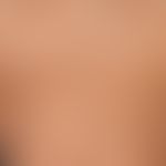 Amyloidosis macular cutaneous: Large, long-standing, continuously spreading, blurred, symmetrical...